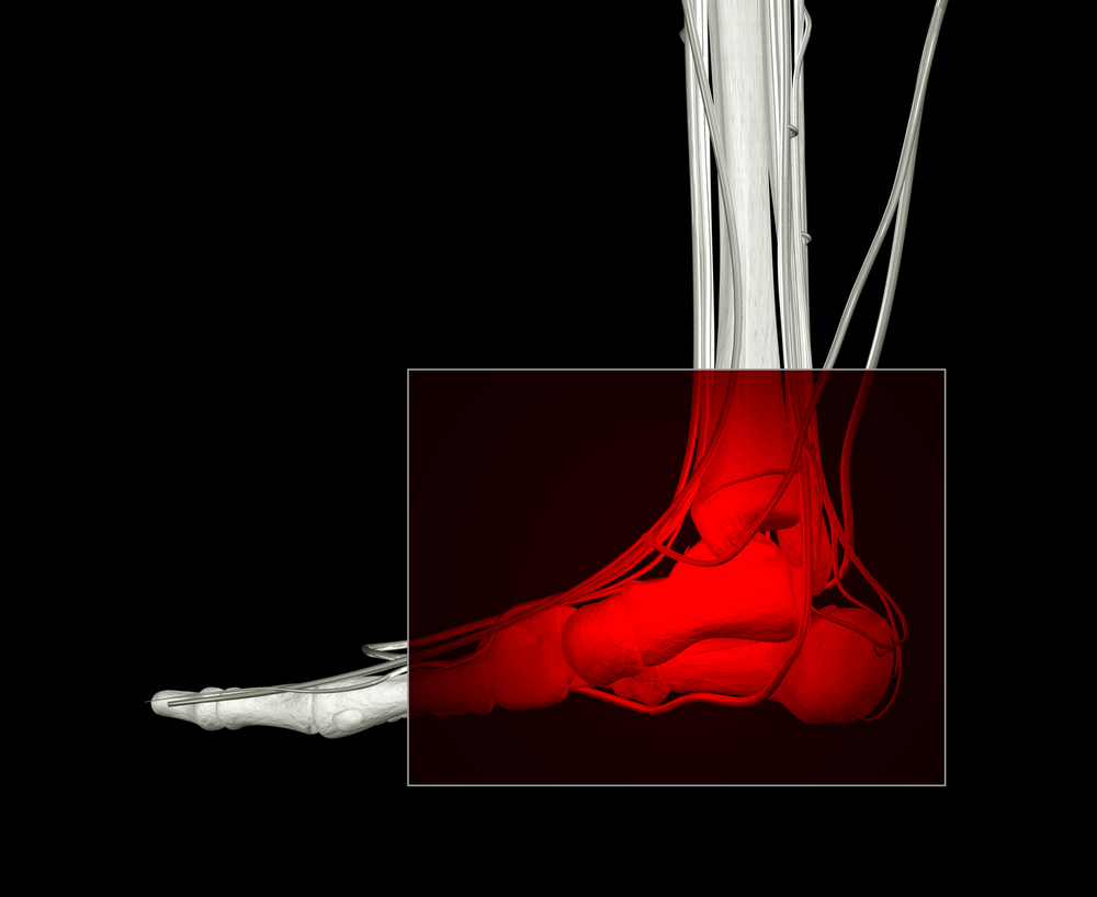 Image for Charcot Foot