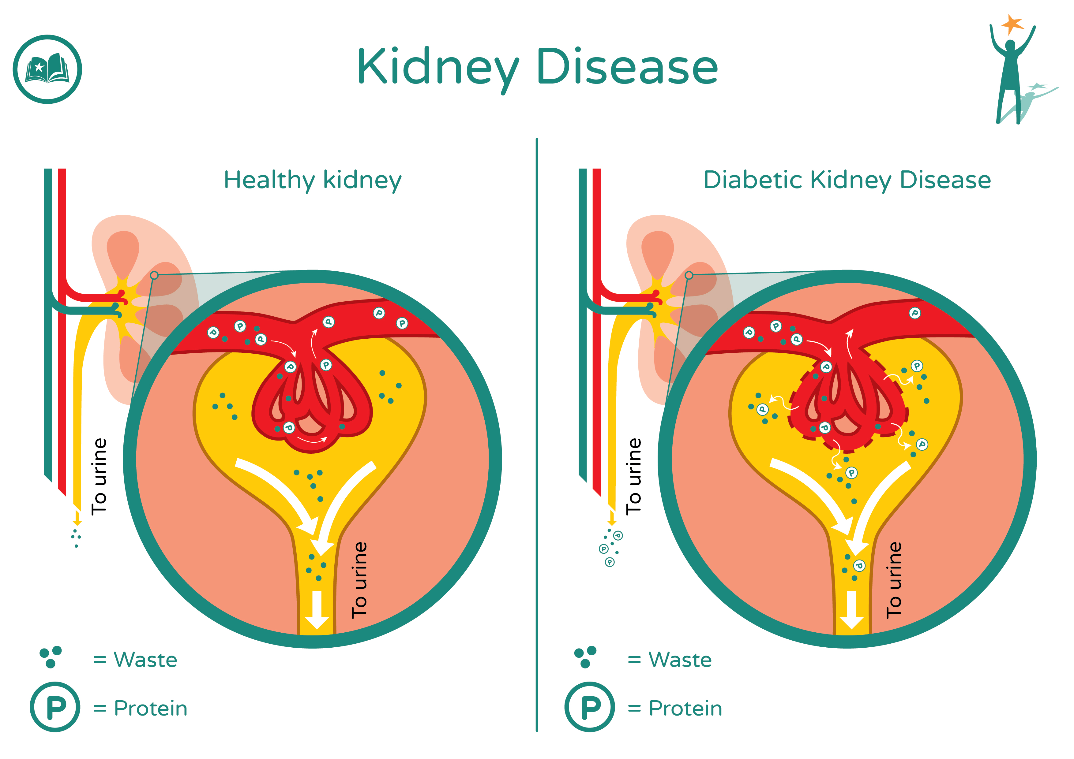 Kidney Disease Diagram V2 