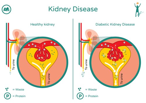 A diagram of a health kidney showing waste being filtered through the kidney and being excreted with urine with no protein present. A diagram showing diabetic kidney disease with leaky valves which show waste and protein being excreted with urine.