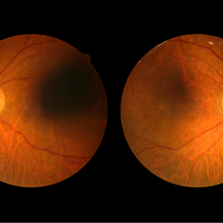 Image for Closer monitoring and treatment of diabetic retinopathy