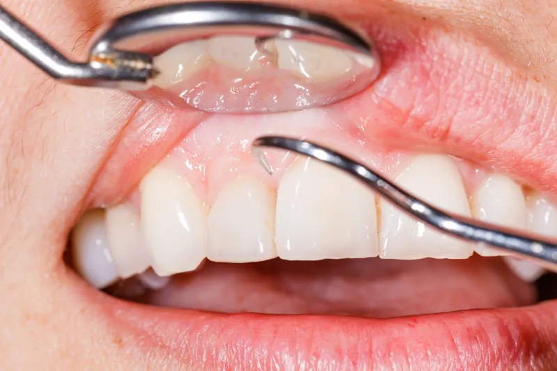 Diabetes and Gum Disease