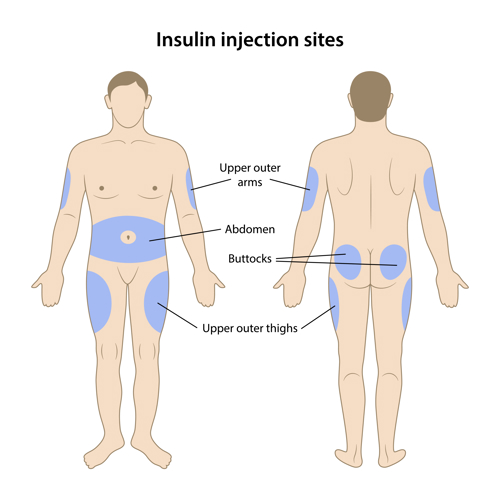 Human figure with different injection sites in the arm, stomach, buttocks and thighs highlighted