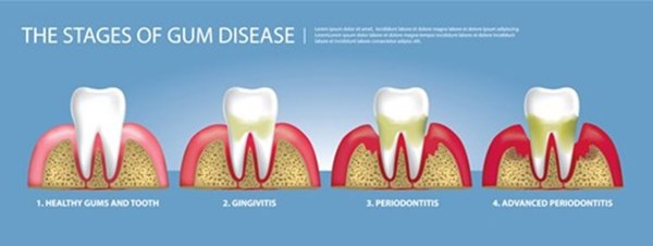 Gum disease.jpg