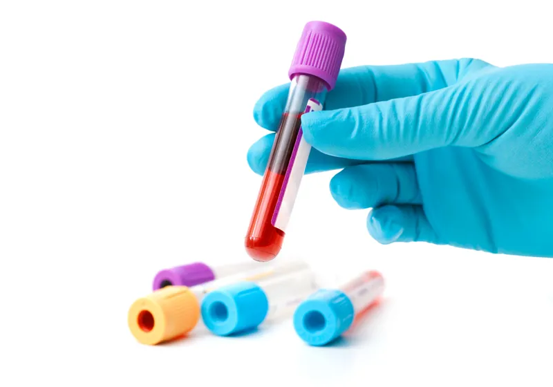 Non-diabetic hyperglycaemia (pre-diabetes)